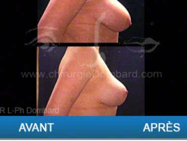 Chirurgie mammaire chirurgie des seins Ptose mammaire varia - DR Dombard Bruxelles - Belgique