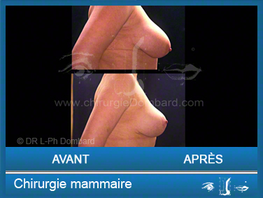 Chirurgie mammaire chirurgie des seins Ptose mammaire varia - DR Dombard Bruxelles - Belgique