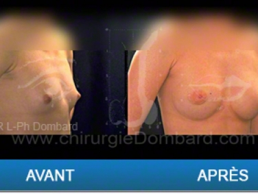 Chirurgie mammaire chirurgie des seins Ptose mammaire varia - DR Dombard Bruxelles - Belgique
