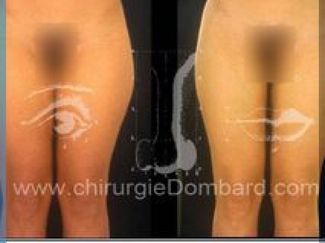 Liposculpture (liposuccion) Culotte Bas des fesses face interne - lipofilling fesses - DR Dombard Bruxelles Belgique