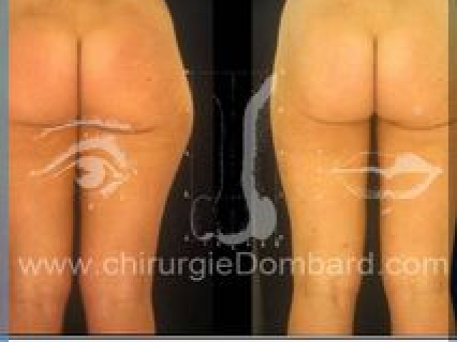 Liposculpture (liposuccion) Culotte Bas des fesses face interne - lipofilling fesses - DR Dombard Bruxelles Belgique