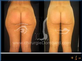 Liposculpture (liposuccion) Culotte Bas des fesses face interne - lipofilling fesses - DR Dombard Bruxelles Belgique