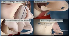 rhinoplastie-neuscorrectie-dr-dombard