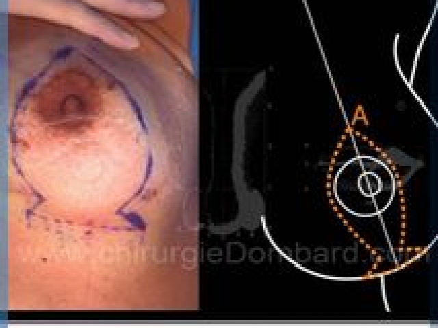 Chirurgie mammaire chirurgie du seins Technique - DR Dombard Bruxelles - Belgique