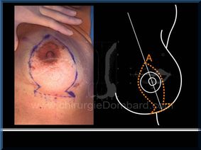 Chirurgie mammaire chirurgie du seins Technique - DR Dombard Bruxelles - Belgique