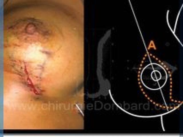 Chirurgie mammaire chirurgie du seins Technique - DR Dombard Bruxelles - Belgique