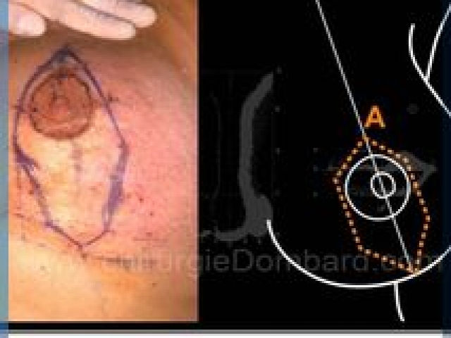 Chirurgie mammaire chirurgie du seins Technique - DR Dombard Bruxelles - Belgique