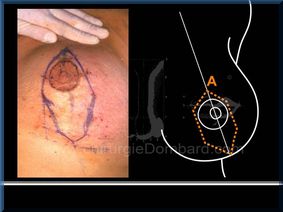 Chirurgie mammaire chirurgie du seins Technique - DR Dombard Bruxelles - Belgique