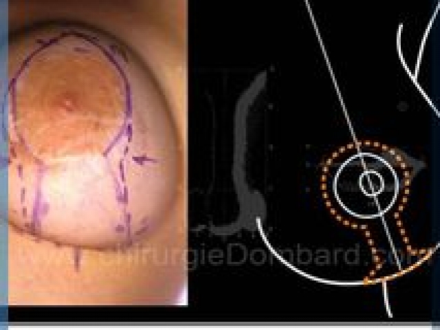 Chirurgie mammaire chirurgie du seins Technique - DR Dombard Bruxelles - Belgique