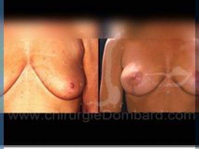Chirurgie mammaire chirurgie seins Ptose mammaire seins tombant - DR Dombard Bruxelles - Belgique