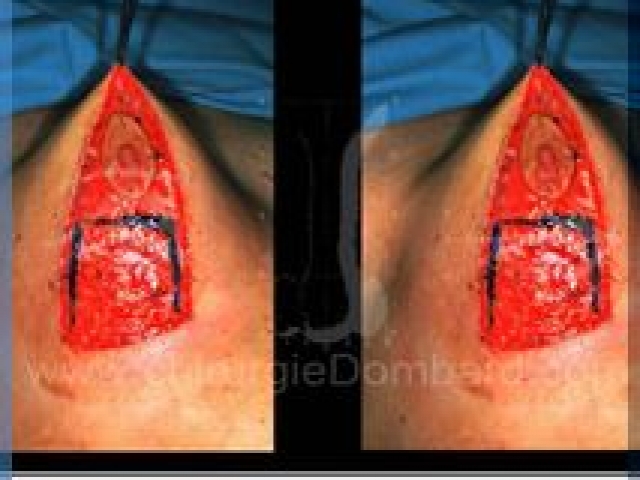 Chirurgie mammaire chirurgie du seins Technique - DR Dombard Bruxelles - Belgique