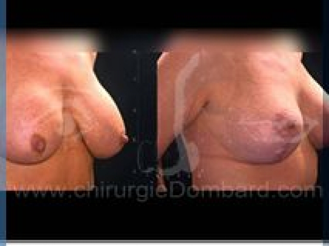 Chirurgie mammaire chirurgie seins Ptose mammaire seins tombant - DR Dombard Bruxelles - Belgique