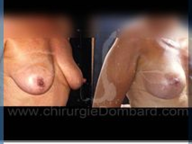 Chirurgie mammaire chirurgie seins Ptose mammaire seins tombant - DR Dombard Bruxelles - Belgique