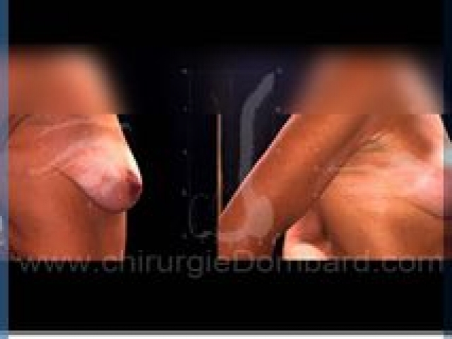 Chirurgie mammaire chirurgie seins Ptose mammaire seins tombant - DR Dombard Bruxelles - Belgique