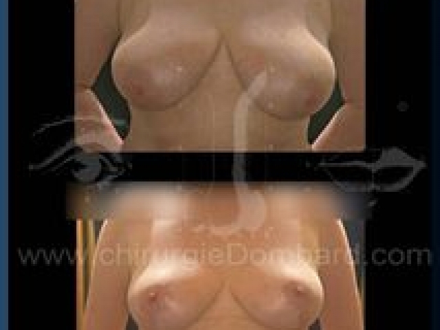 Chirurgie mammaire chirurgie seins Ptose mammaire seins tombant - DR Dombard Bruxelles - Belgique