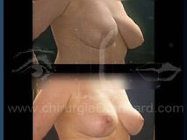 Chirurgie mammaire chirurgie seins Ptose mammaire seins tombant - DR Dombard Bruxelles - Belgique