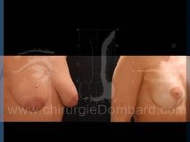 Chirurgie mammaire chirurgie seins Ptose mammaire seins tombant - DR Dombard Bruxelles - Belgique