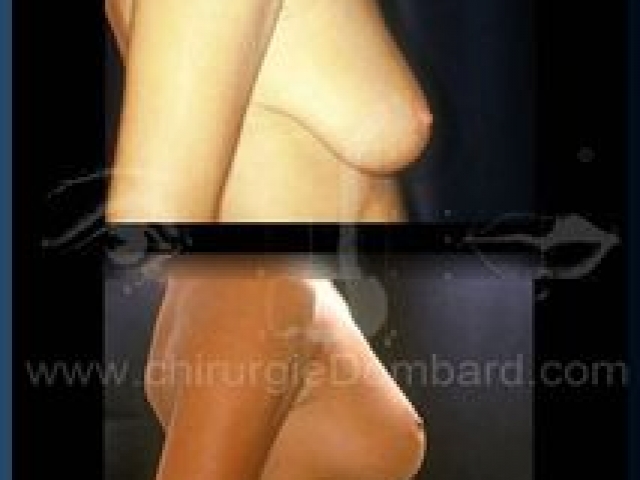 Chirurgie mammaire chirurgie seins Ptose mammaire seins tombant - DR Dombard Bruxelles - Belgique