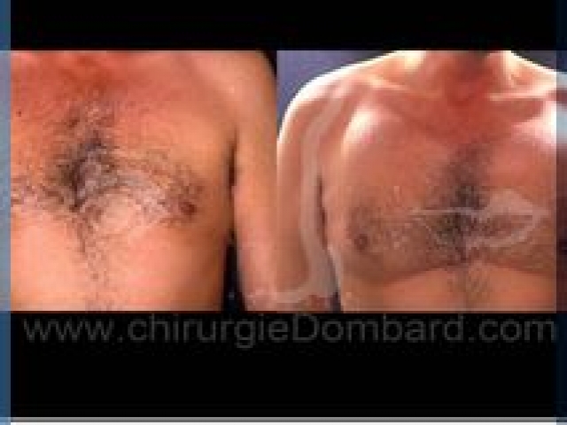 Avant – Après – Chirurgie mammaire chirurgie seins pour homme Les pectoraux - DR Dombard Bruxelles - Belgique