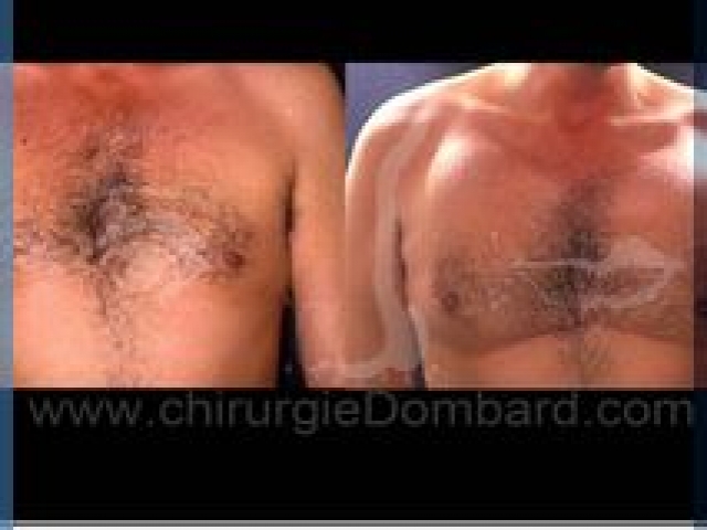 Avant – Après – Chirurgie mammaire chirurgie seins pour homme Les pectoraux - DR Dombard Bruxelles - Belgique