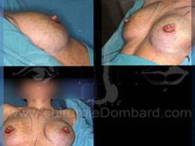 Chirurgie mammaire chirurgie du seins Technique - DR Dombard Bruxelles - Belgique