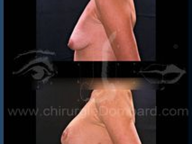 Chirurgie mammaire chirurgie seins Ptose mammaire seins tombant - DR Dombard Bruxelles - Belgique