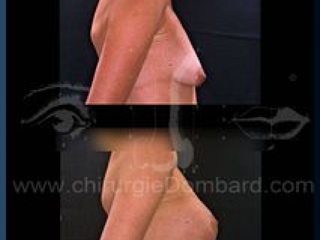 Chirurgie mammaire chirurgie seins Ptose mammaire seins tombant - DR Dombard Bruxelles - Belgique