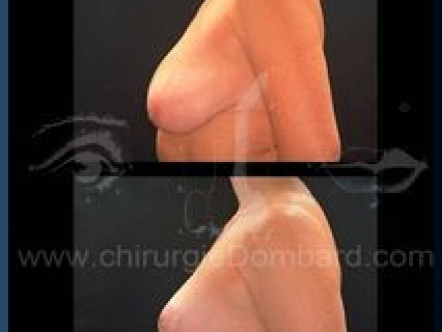 Chirurgie mammaire chirurgie seins Ptose mammaire seins tombant - DR Dombard Bruxelles - Belgique