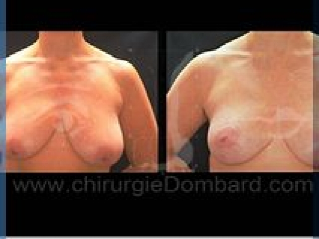 Chirurgie mammaire chirurgie seins Ptose mammaire seins tombant - DR Dombard Bruxelles - Belgique