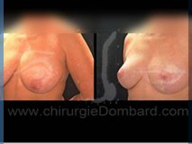 Chirurgie mammaire chirurgie seins Ptose mammaire seins tombant - DR Dombard Bruxelles - Belgique