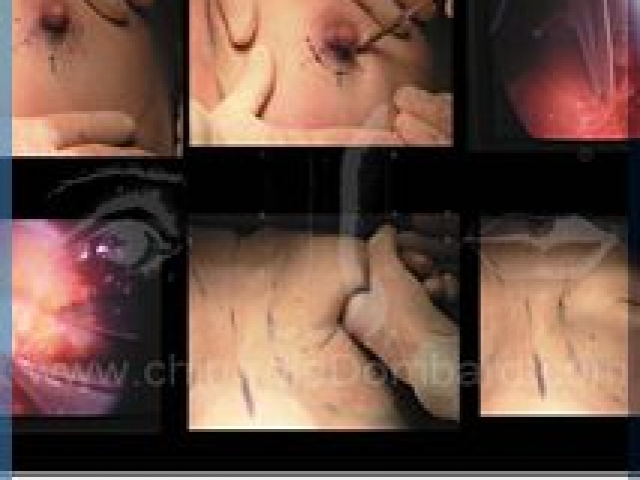 Chirurgie mammaire chirurgie du seins Technique - DR Dombard Bruxelles - Belgique
