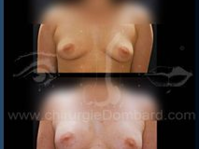 Augmentation mammaire en Belgique par spécialiste.