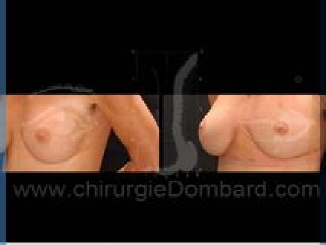 Chirurgie mammaire chirurgie seins avec changement de prothèses - DR Dombard Bruxelles Belgique