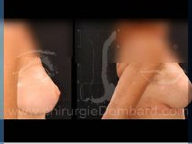 Chirurgie mammaire chirurgie seins avec changement de prothèses - DR Dombard Bruxelles Belgique