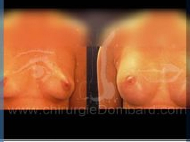 Augmentation mammaire en Belgique par spécialiste.