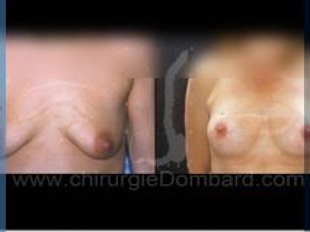 Chirurgie mammaire chirurgie seins Ptose mammaire seins tombant - DR Dombard Bruxelles - Belgique