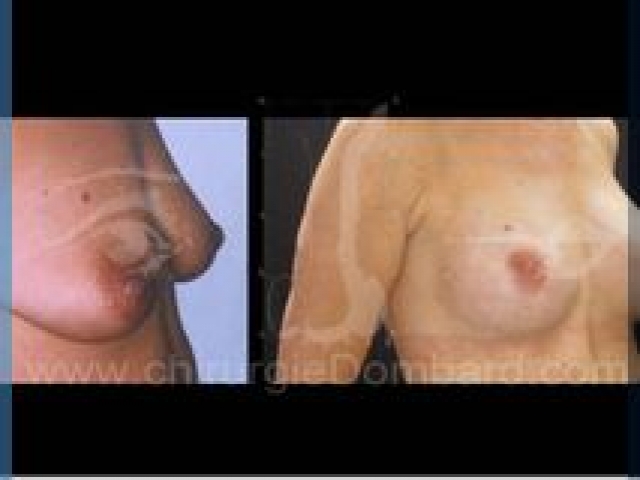 Chirurgie mammaire chirurgie seins Ptose mammaire seins tombant - DR Dombard Bruxelles - Belgique