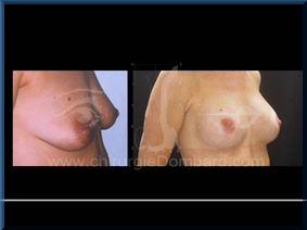 Chirurgie mammaire chirurgie seins Ptose mammaire seins tombant - DR Dombard Bruxelles - Belgique
