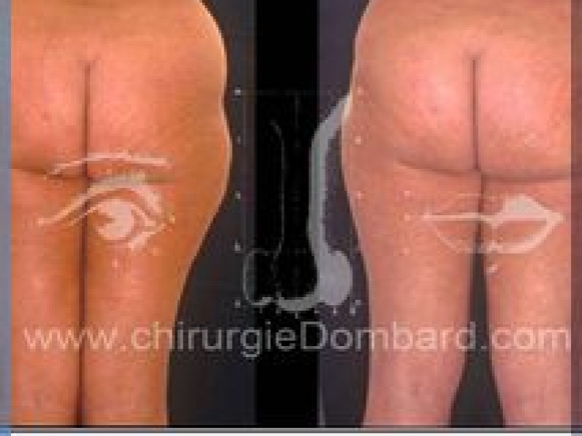Liposculpture (liposuccion) taille et hanches – Abdomen - DR Dombard Bruxelles Belgique