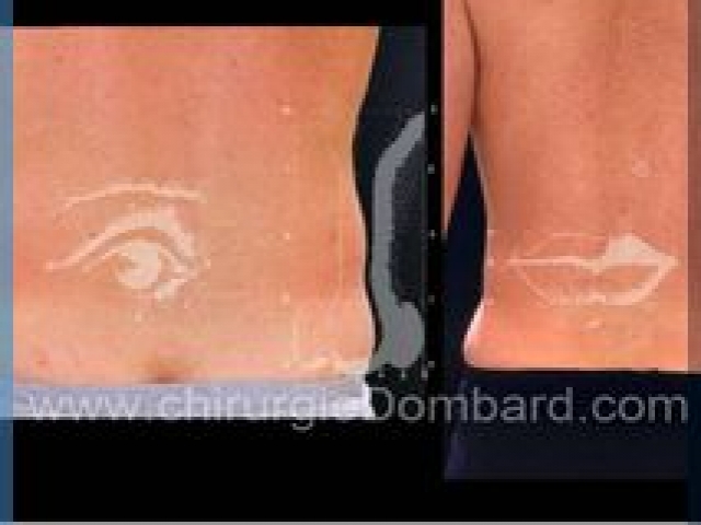 Liposculpture (liposuccion) taille et hanches – Abdomen - DR Dombard Bruxelles Belgique