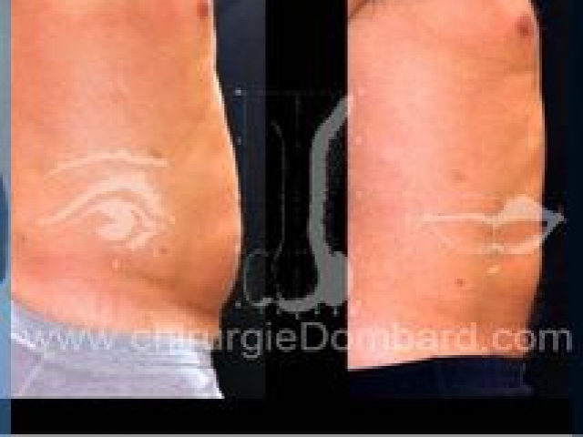 Liposculpture (liposuccion) taille et hanches – Abdomen - DR Dombard Bruxelles Belgique