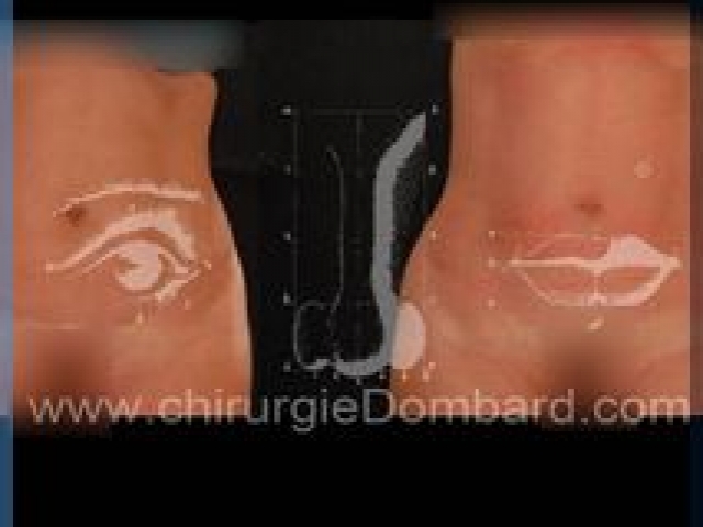 Liposculpture (liposuccion) taille et hanches – Abdomen - DR Dombard Bruxelles Belgique
