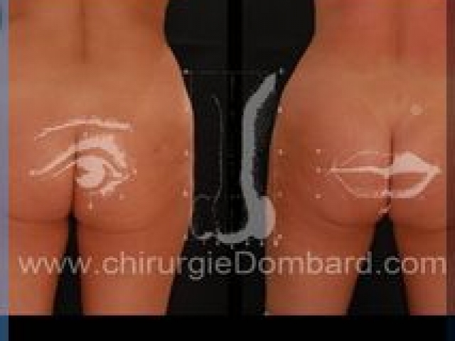 Liposculpture (liposuccion) taille et hanches – Abdomen - DR Dombard Bruxelles Belgique