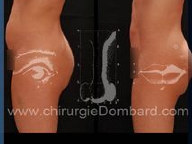 Liposculpture (liposuccion) taille et hanches – Abdomen - DR Dombard Bruxelles Belgique