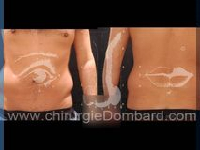 Liposculpture (liposuccion) taille et hanches – Abdomen - DR Dombard Bruxelles Belgique