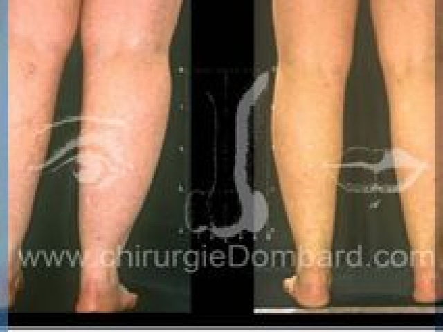 Liposculpture (liposuccion) chevilles mollets - DR Dombard Bruxelles Belgique