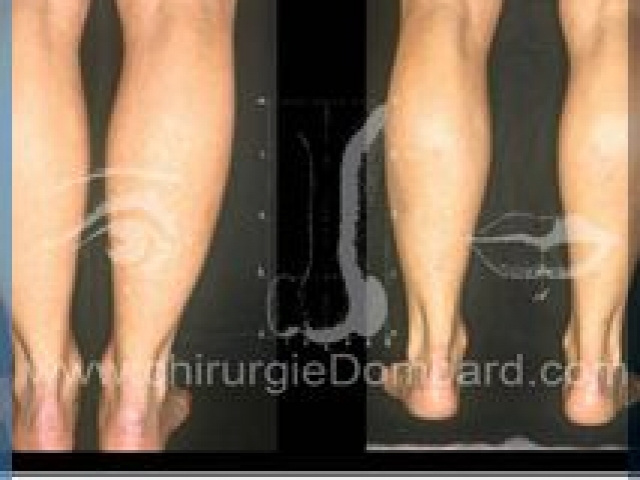 Liposculpture (liposuccion) chevilles mollets - DR Dombard Bruxelles Belgique
