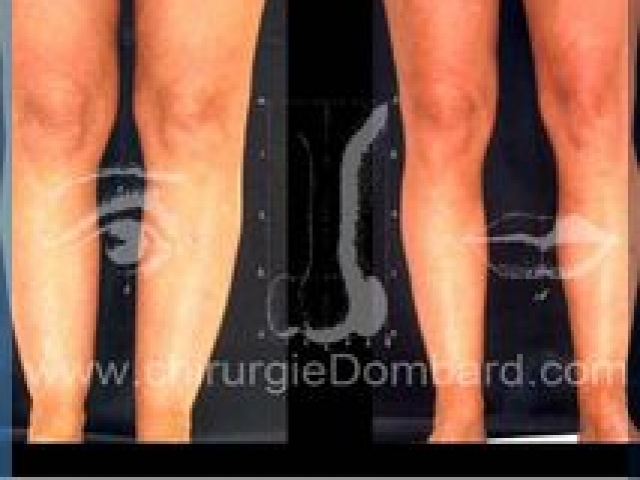 Liposculpture (liposuccion) chevilles mollets - DR Dombard Bruxelles Belgique