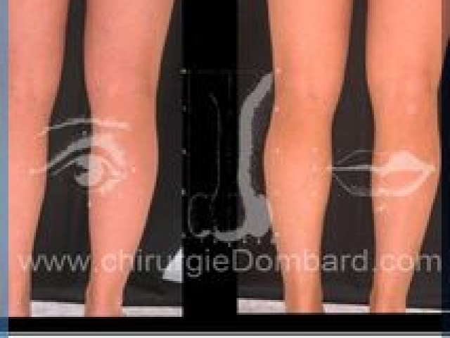 Liposculpture (liposuccion) chevilles mollets - DR Dombard Bruxelles Belgique