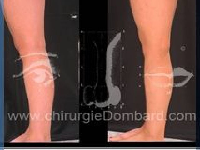 Liposculpture (liposuccion) chevilles mollets - DR Dombard Bruxelles Belgique